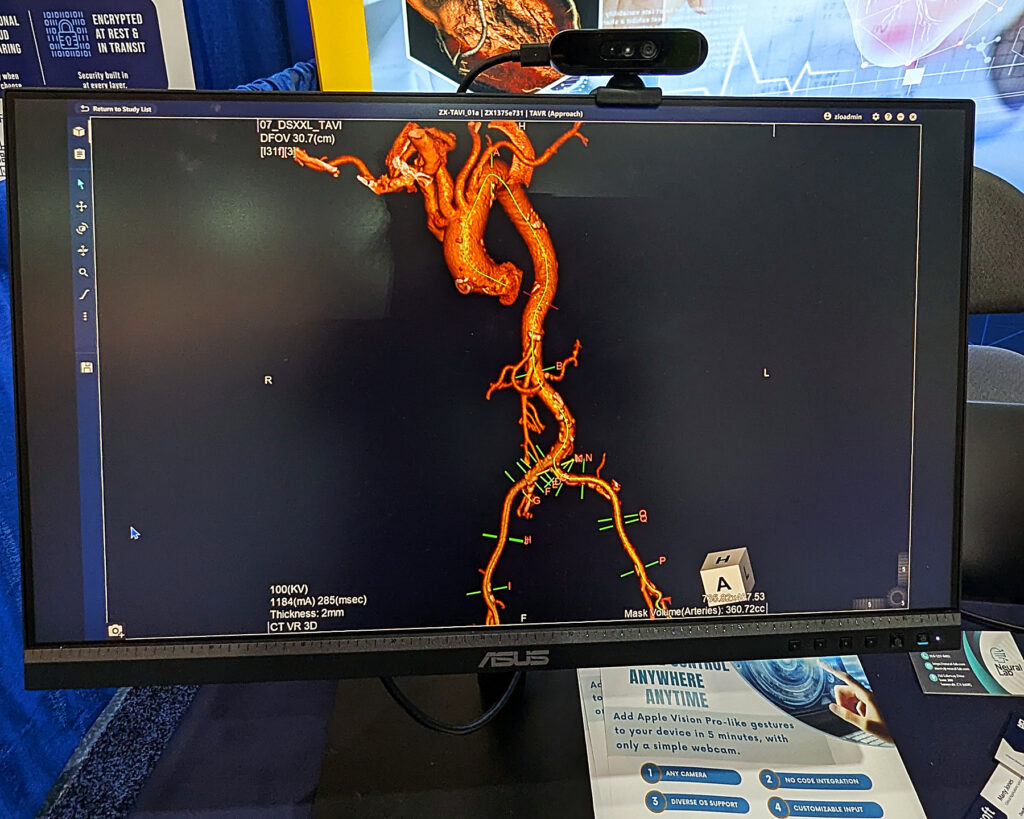 Orbbec Gemini 336 camera mounted above ASUS monitor displaying 3D CT aorta visualization, controlled via AirTouch touchless gesture interface in a medical environment