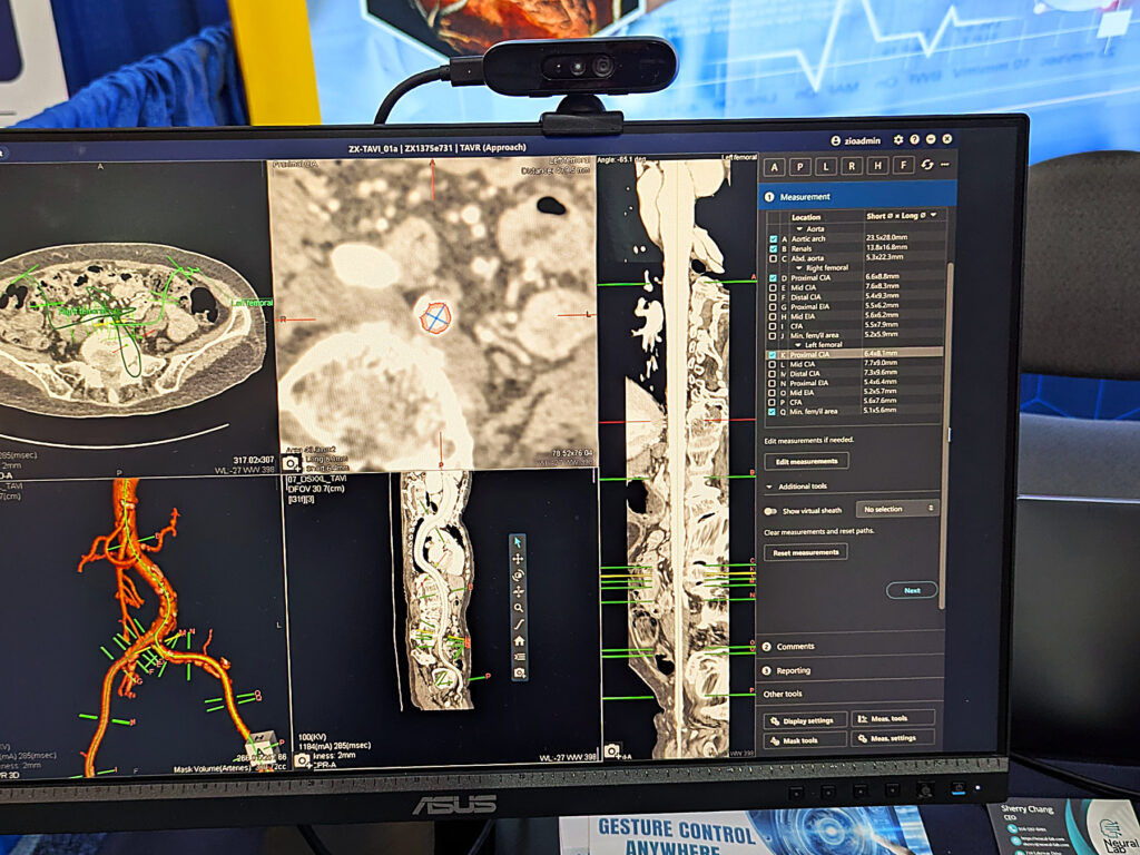 Orbbec Gemini 336 stereo 3D camera mounted on clinical workstation displaying multi-panel CT vascular imaging with AirTouch gesture control interface, showing measurement data and 3D vessel reconstruction
